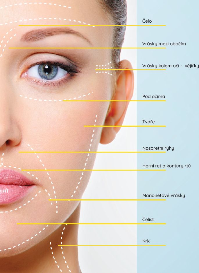 10-oblasti-hyaluronic filler